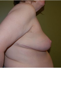 After Image: Breast Reduction - other