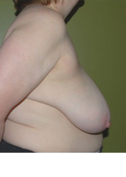 Before Image: Breast Reduction - other