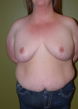 After Image: Breast Reduction - front