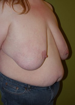Before Image: Breast Reduction - right-front-oblique