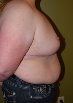 After Image: Breast Reduction - other
