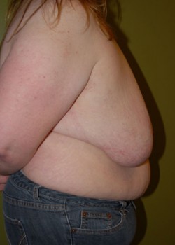 Before Image: Breast Reduction - other