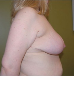 After Image: Breast Reduction - front