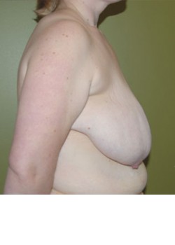 Before Image: Breast Reduction - front