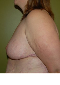 After Image: Breast Reduction - other