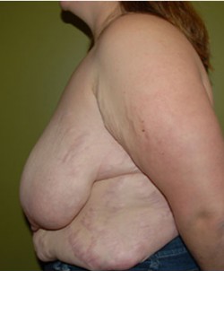 Before Image: Breast Reduction - other