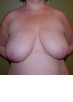 Before Image: Breast Reduction - front