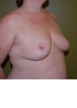 After Image: Breast Reduction - right-front-oblique