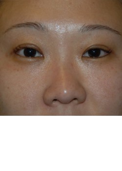 After Image: Asian Double Eyelid - front
