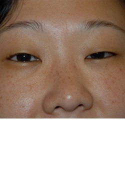 Before Image: Asian Double Eyelid - front