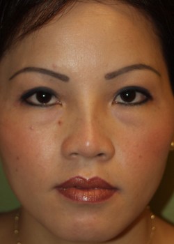 After Image: Asian Double Eyelid and Higher Nose Bridge - front