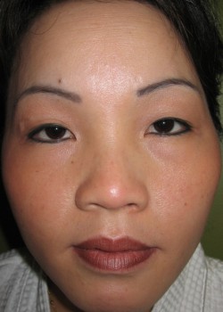 Before Image: Asian Double Eyelid and Higher Nose Bridge - front