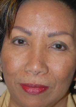 After Image: Upper Eyelid - front