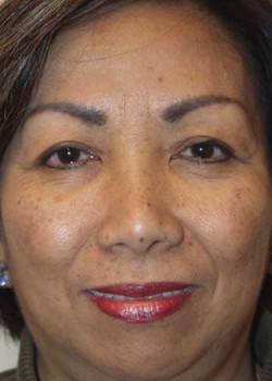 Before Image: Upper Eyelid - front