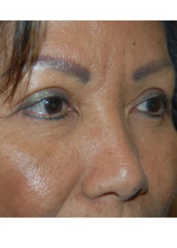 After Image: Upper Eyelid - right-front-oblique