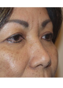 Before Image: Upper Eyelid - right-front-oblique