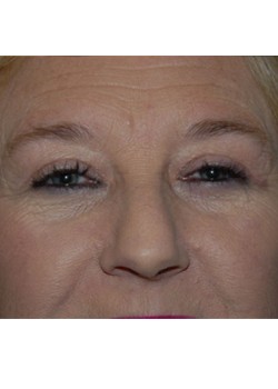 After Image: Upper Eyelid - front