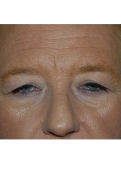 Before Image: Upper Eyelid - front