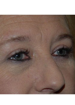 After Image: Upper Eyelid - right-front-oblique