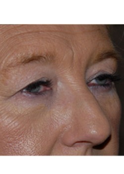 Before Image: Upper Eyelid - right-front-oblique
