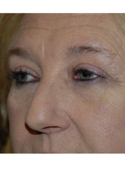 After Image: Upper Eyelid - left-front-oblique