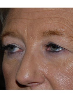 Before Image: Upper Eyelid - left-front-oblique