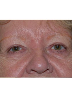 After Image: Upper Eyelid - front