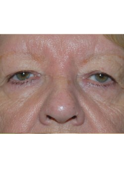 Before Image: Upper Eyelid - front
