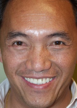 After Image: Upper and Lower Eyelid - front