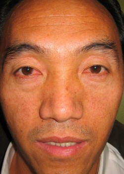 Before Image: Upper and Lower Eyelid - front