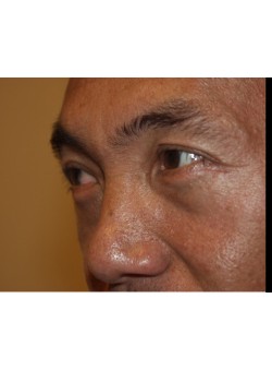 After Image: Upper and Lower Eyelid - left-front-oblique