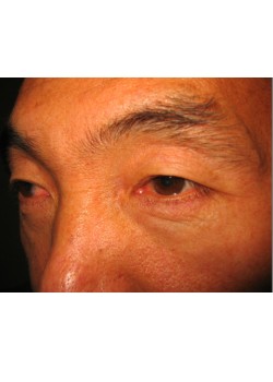 Before Image: Upper and Lower Eyelid - left-front-oblique