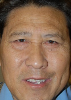 After Image: Lower Eyelid - front