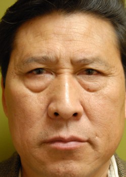 Before Image: Lower Eyelid - front