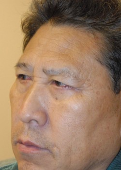 After Image: Lower Eyelid - left-front-oblique