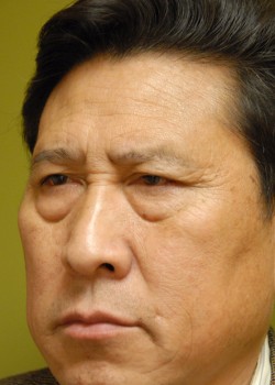 Before Image: Lower Eyelid - left-front-oblique