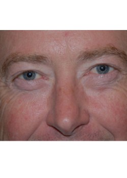 After Image: Lower Eyelid - front