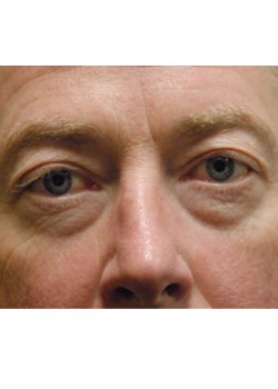 Before Image: Lower Eyelid - front