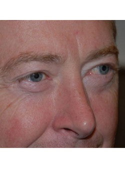 After Image: Lower Eyelid - right-front-oblique