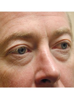 Before Image: Lower Eyelid - right-front-oblique