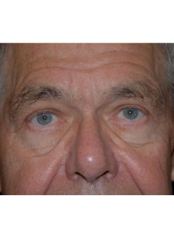 After Image: Upper Eyelid - front