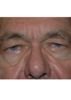 Before Image: Upper Eyelid - front