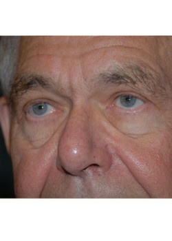 After Image: Upper Eyelid - left-front-oblique