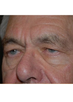 Before Image: Upper Eyelid - left-front-oblique