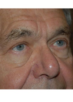 After Image: Upper Eyelid - right-front-oblique