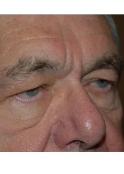 Before Image: Upper Eyelid - right-front-oblique
