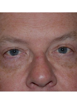 After Image: Upper Eyelid - front