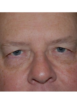 Before Image: Upper Eyelid - front