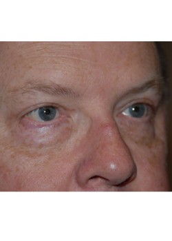 After Image: Upper Eyelid - right-front-oblique