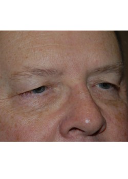 Before Image: Upper Eyelid - right-front-oblique